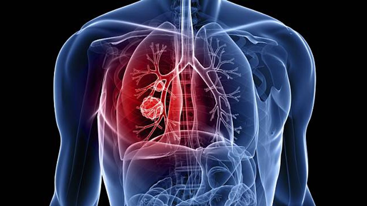 Akciğer kanserinde yeni tedavi yöntemi