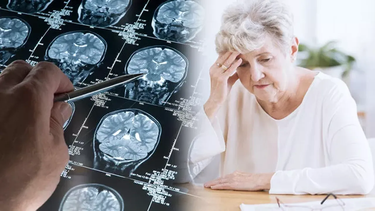 Yeni bulunan Alzheimer  ilacı hastalığın ilerlemesini  üçte bir yavaşlatıyor