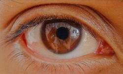 Sinsi Hastalık Körlüğe Götürüyor